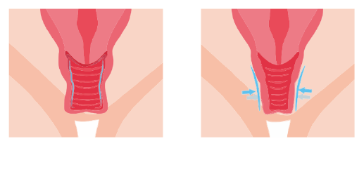 योनि की मांसपेशियों की टोन को पुनर्स्थापित करें, पकड़ और जलयोजन में सुधार करें और यौन जीवन की गुणवत्ता में सुधार करें।