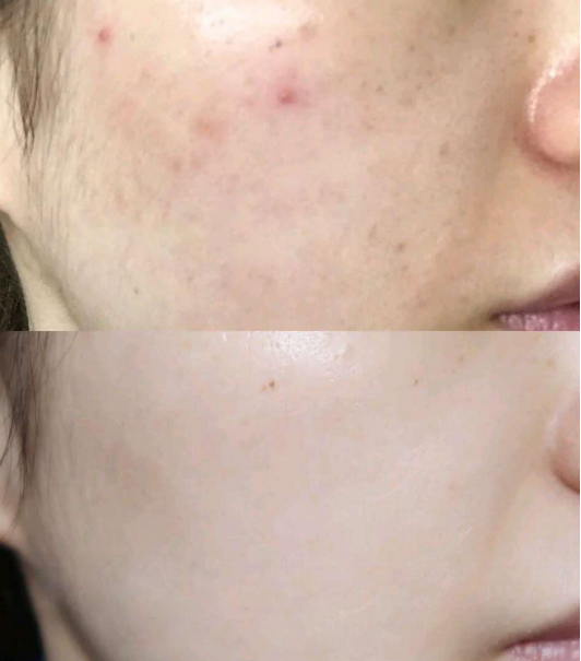 acne removal treatment