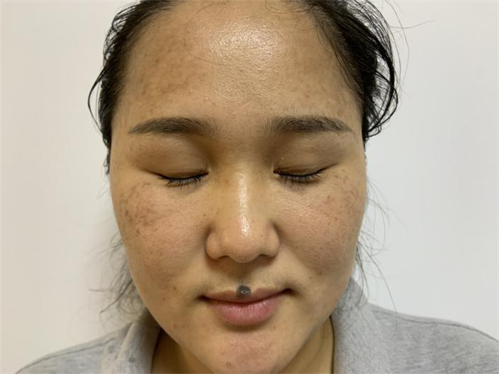 Treatment result pictures (15)