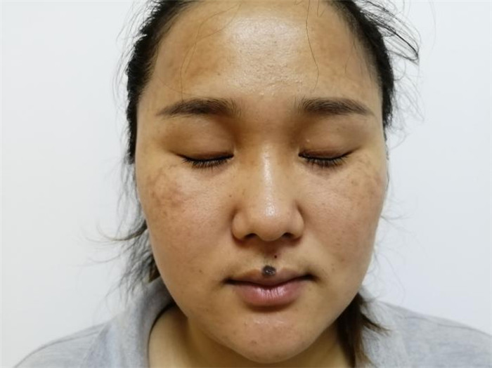 Treatment result pictures (3)