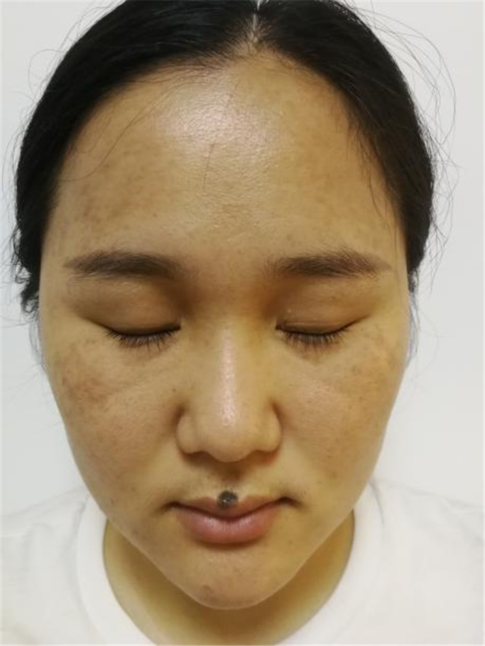 Treatment result pictures (5)