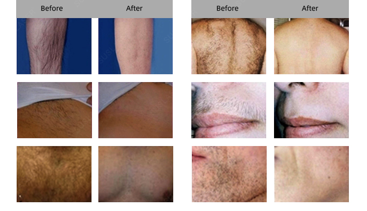 before and after of hair removal