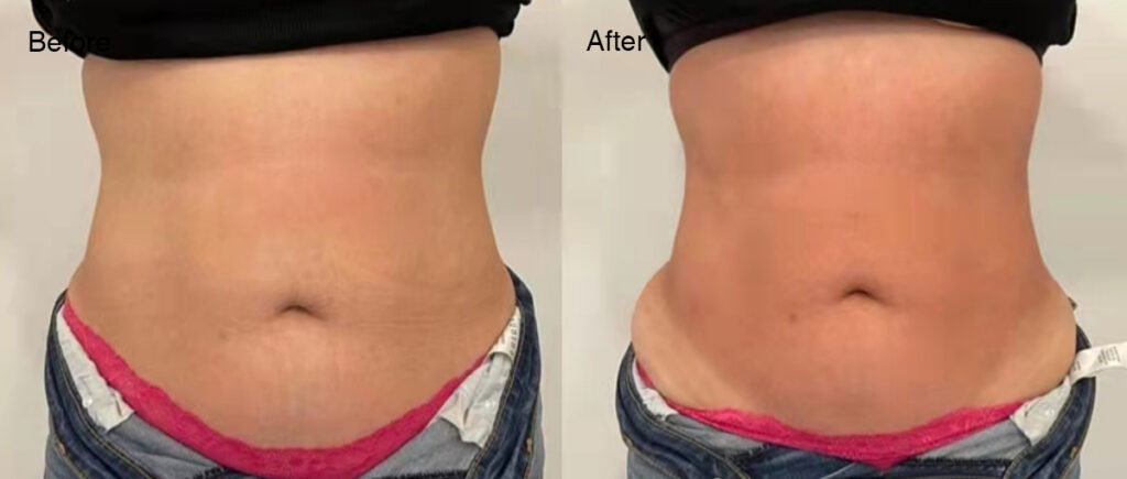 Lipo Laser 3 1 23