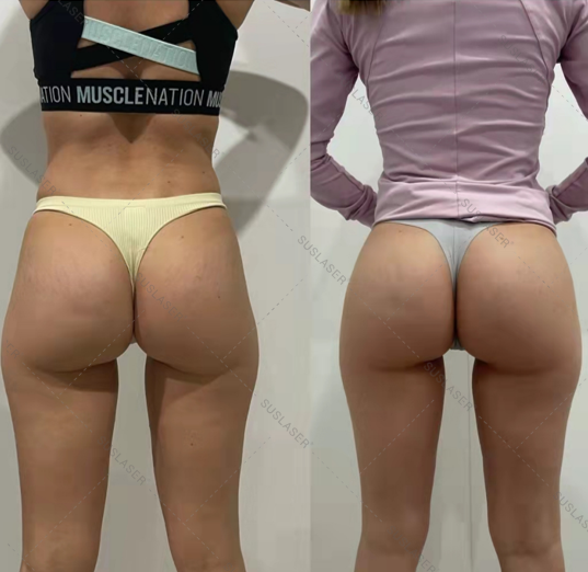 High Power Electromagnetic Muscle Stimulator &Amp; Pelvic Floor Muscle Training Machine 17 ハイパワーボディスカルプティング&骨盤底引き締め電磁筋刺激装置