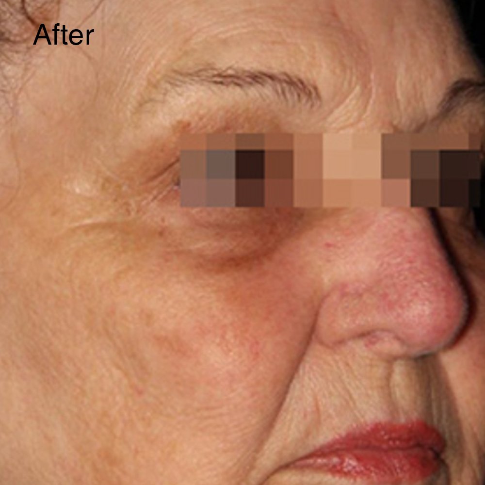 Hifu Non-Invasive Treatment 5 4 10