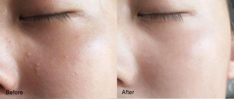 Skin Whitening 3 1 1