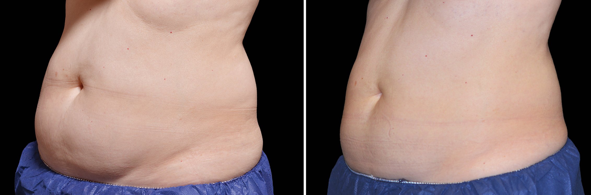 Cellulite Reduction 1 Ab Bodi 004F16W Flv 2Set