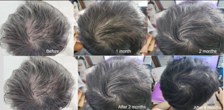 Hair Regrowth 1 Eric 头发