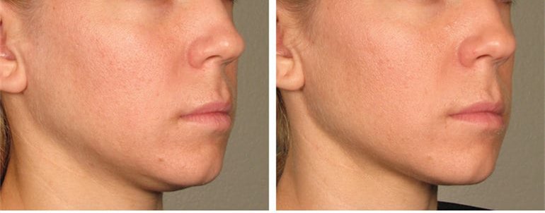 Hifu Non-Invasive Treatment 3 Before After Ultherapy Results Full Face23
