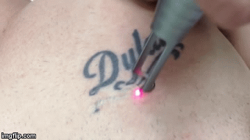 レーザータトゥー除去とは何ですか? 3 Tattoo Removalgif