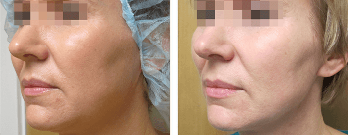 Ultherapy Treatment Face Before And After Pictures 0001