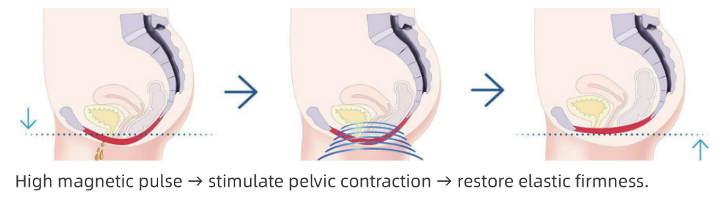 Pelvic Floor Muscle Training 1 图片1