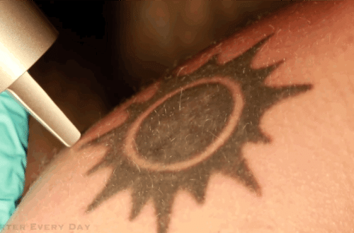 Tattoo-Removal